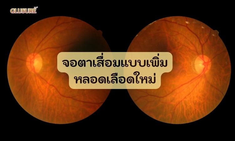 โรคเบาหวานทำให้เกิดการสร้างหลอดเลือดในจอประสาทตา
